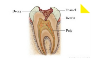 tooth decay stages 1