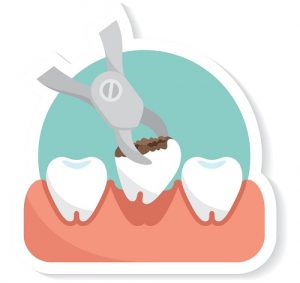 tooth extraction image