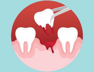 tooth removing image