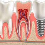 tooth replacement options featured image