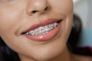 traditional metal braces image