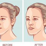 underbite causes and treatment featured image