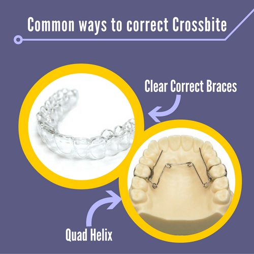 ways to correct crossbite