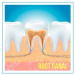 what is a root canal